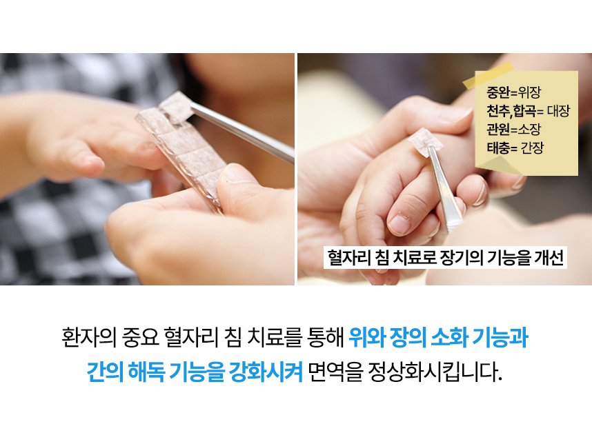 환자의 중요 혈자리 침치료를 통해 위와 장의 소화기능과 간의 해독기능을 강화시켜 면역을 정상화 시킵니다.