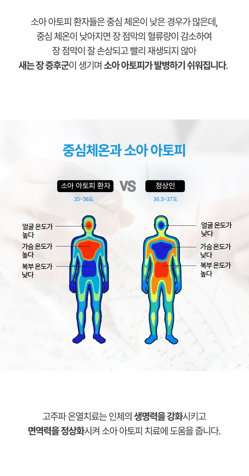 중심 체온이 낮아지면 장 점막의 혈류량이 감소하여 장 점막이 잘 손상되고 빨리 재생되지 않아 새는 장 증후군이 생기며 유소아 아토피가 발병하기 쉬워집니다. 고주파 온열치료는 인체의 생명력을 강화시키고 면역력을 정상화시켜 유소아 아토피 치료에 도움을 줍니다.