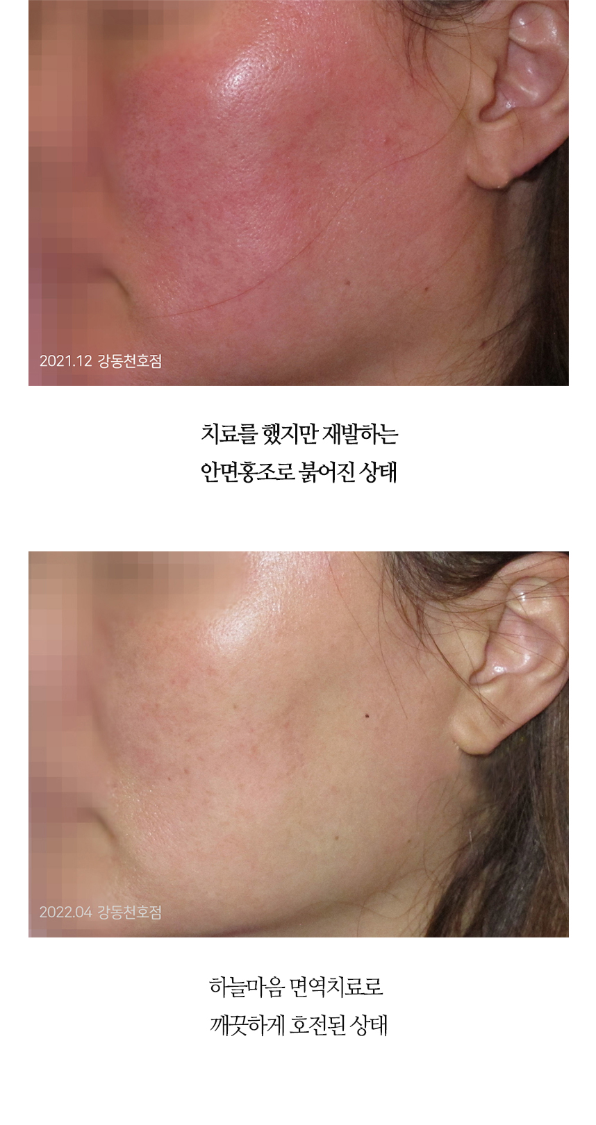 치료전후 이미지1