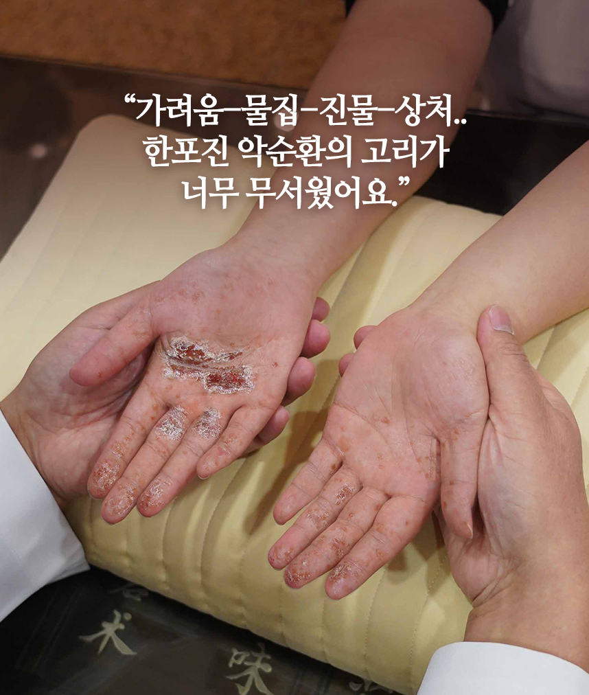 가려움-물집-진물-상처.. 한포진 악순환의 고리가 너무 무서웠어요.