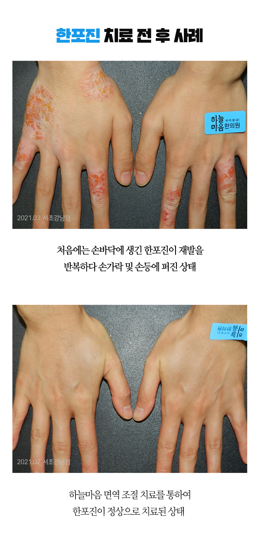 치료전후 이미지1