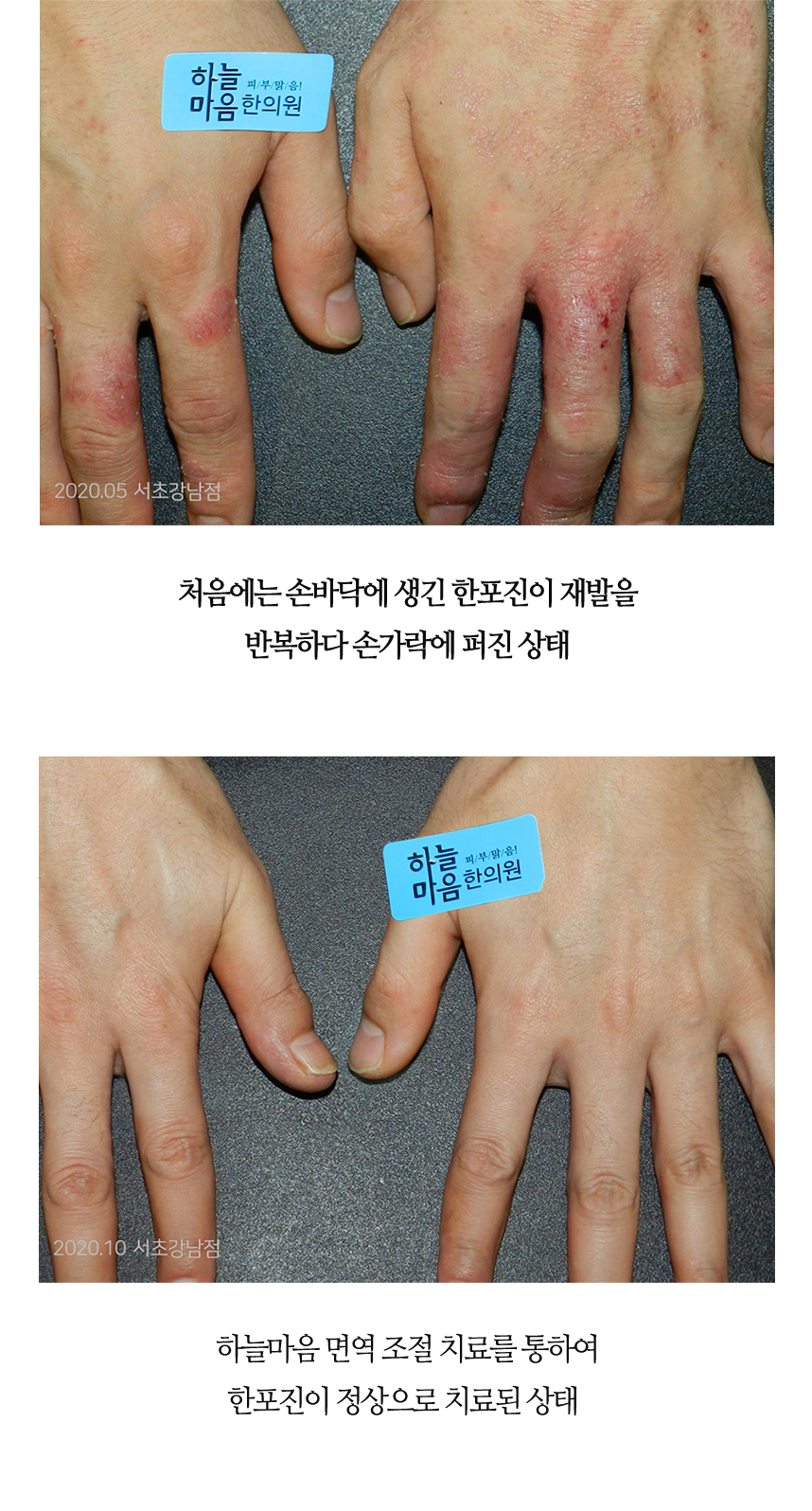 치료전후 이미지2
