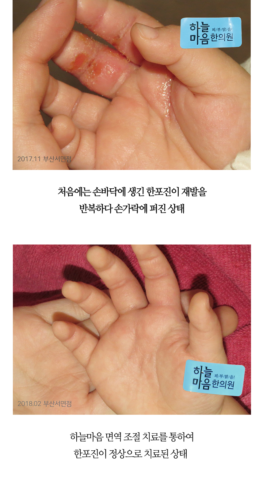 치료전후 이미지3