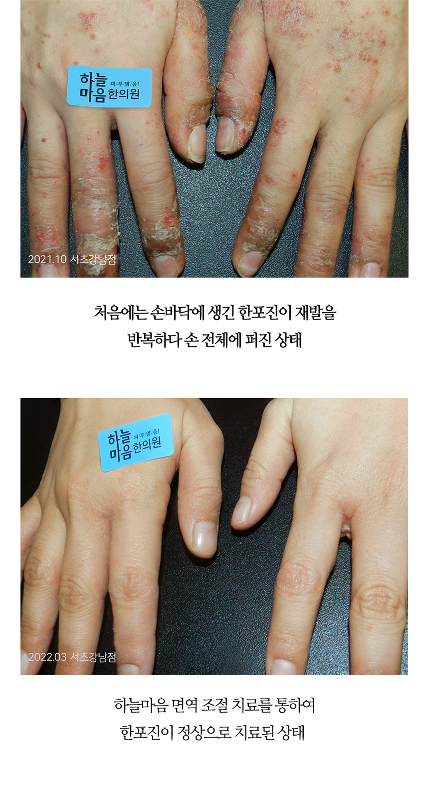 치료전후 이미지4