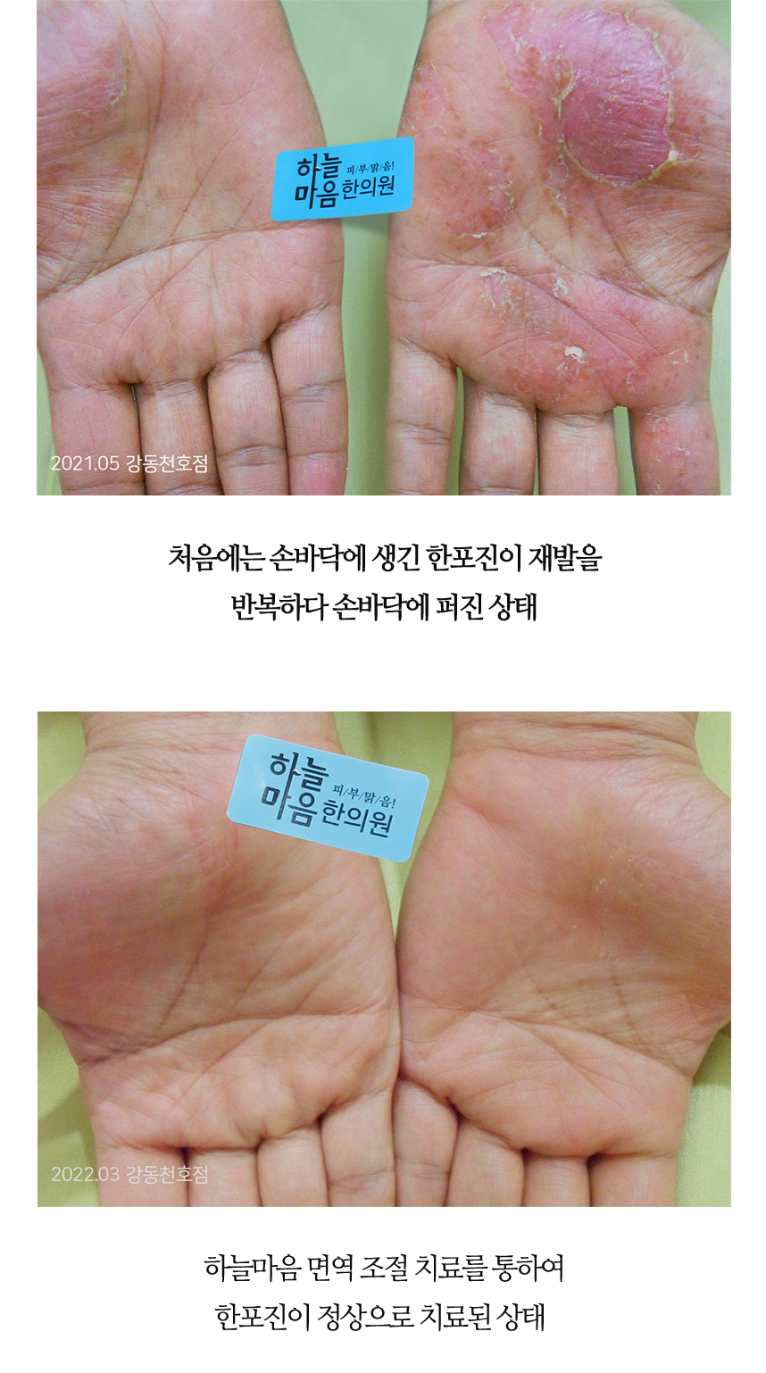 치료전후 이미지5
