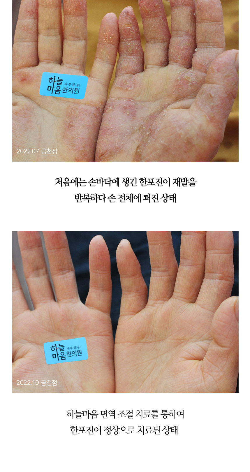 치료전후 이미지6