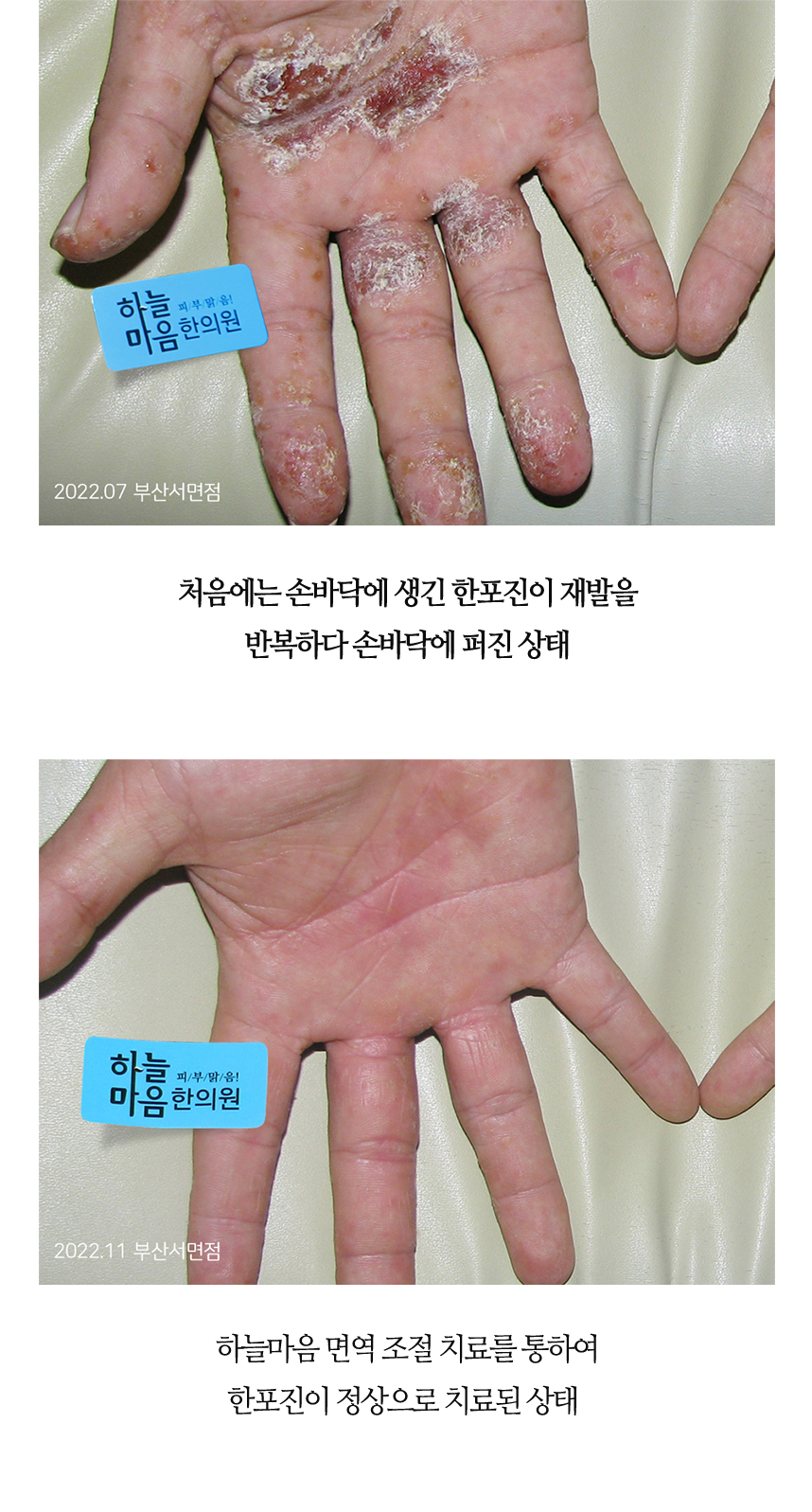 치료전후 이미지7