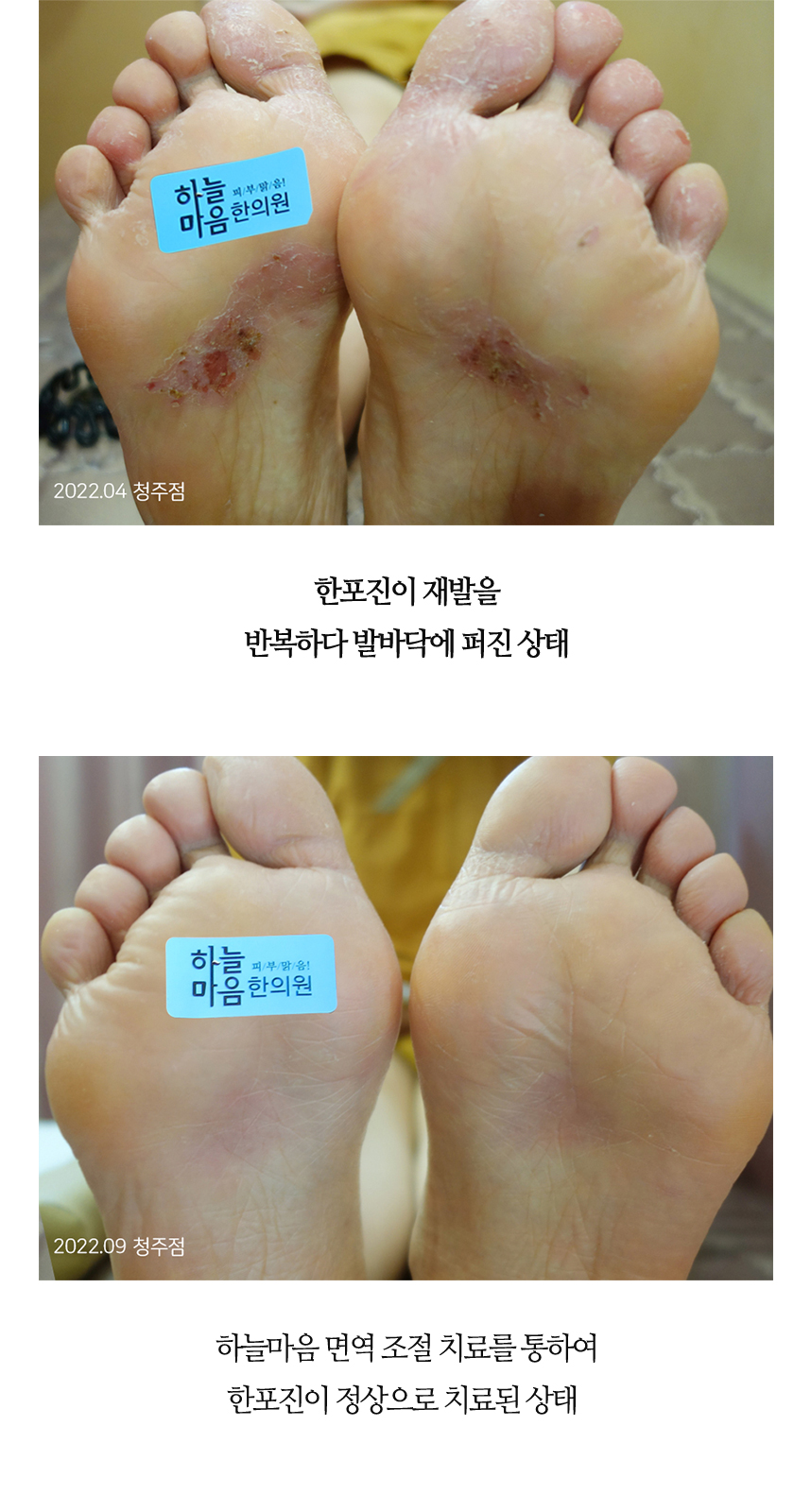 치료전후 이미지8