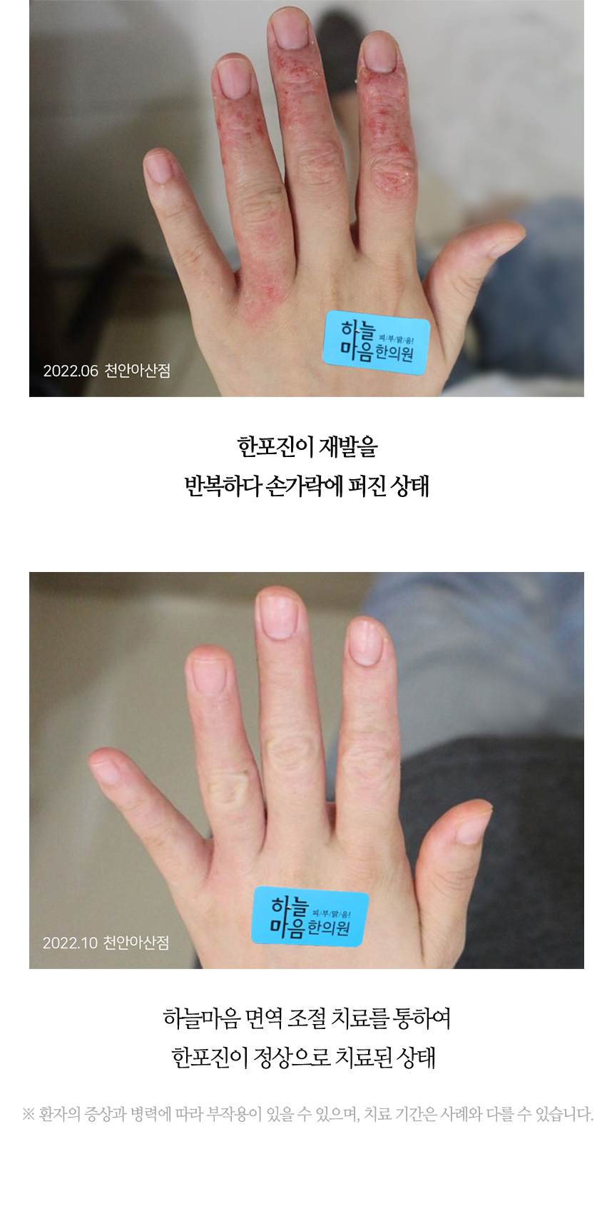 치료전후 이미지9