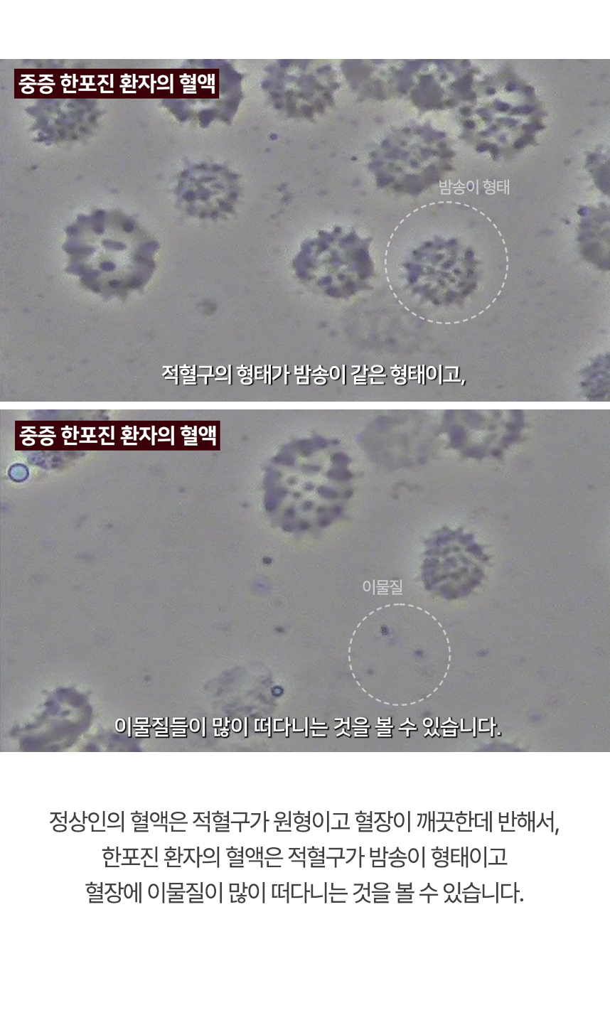 정상인의 혈액은 적혈구가 원형이고 혈장이 깨끗한데 반해서, 한포진 환자의 혈액은 적혈구가 밤송이 형태이고 혈장에 이물질이 많이 떠다니는 것을 볼 수 있습니다.