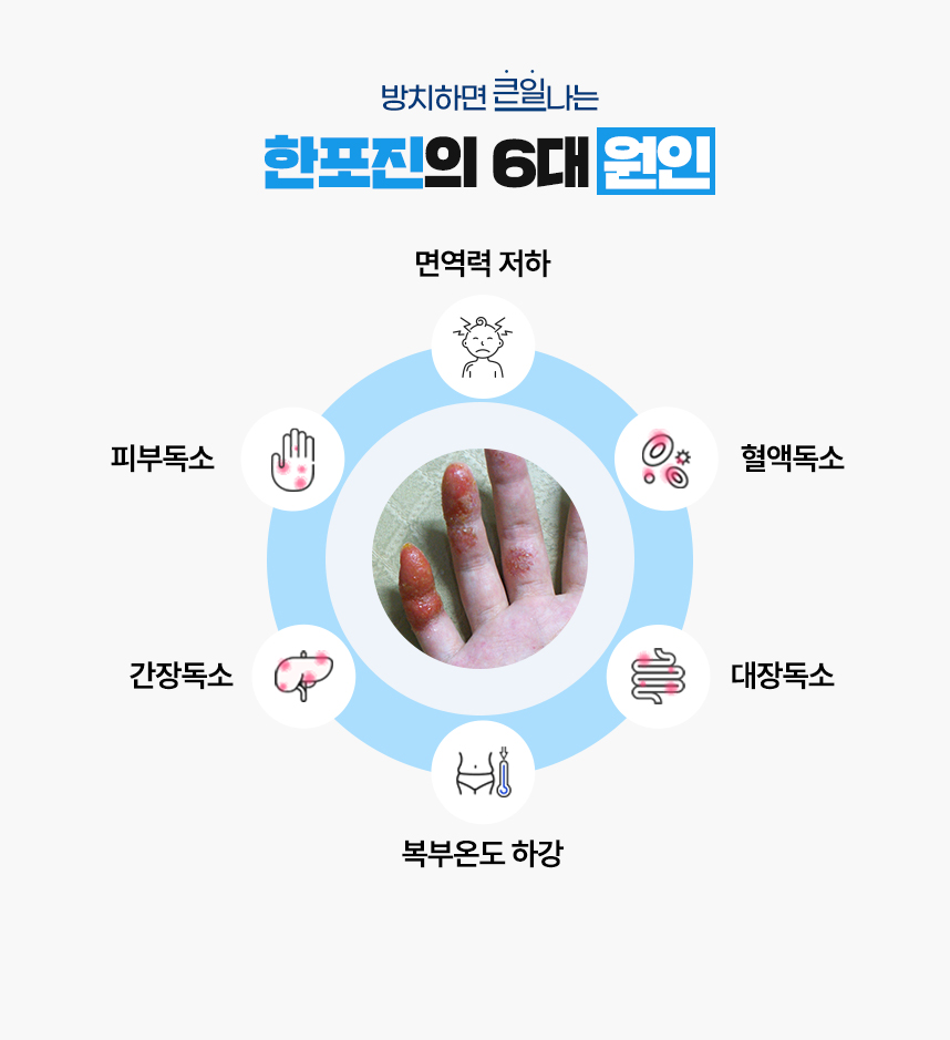 또한 한포진 증상이 있는 피부 온도는 높게 상승되어 있고 복부 온도는 낮게 하강되어 있는 병리적인 특성이 있어 이 6가지를 한포진이 발병하는 6대 원인으로 보고 있습니다.