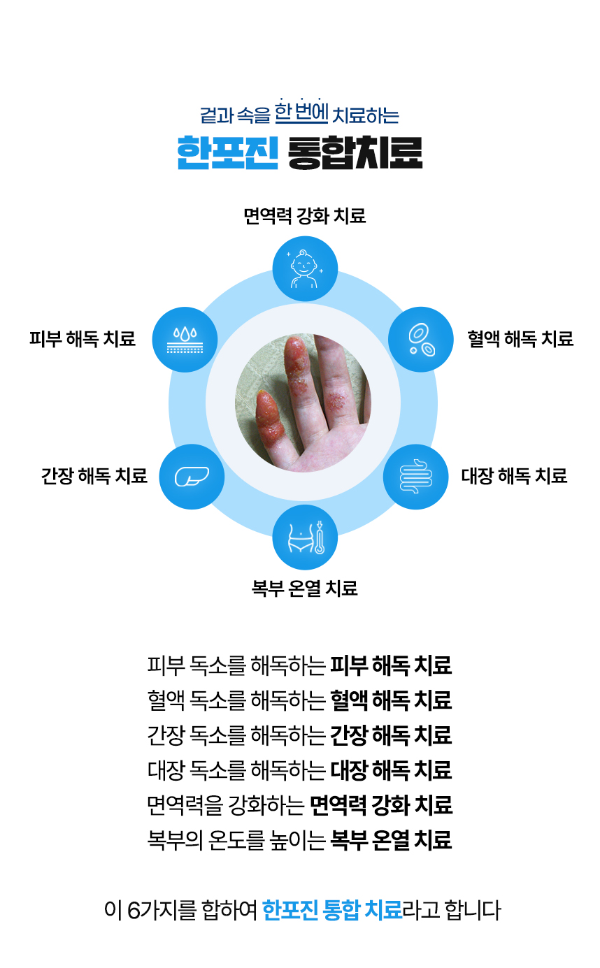 겉과 속을 함번에 치료하는 한포진 통합치료 / 사중독소 장독소, 간독소, 혈액독소, 피부독소 사중독소의 4중 해독 치료 피부, 피부의 열을 내리는 피부 청열 치료, 복부의 온도를 높이는 복부 온열 치료