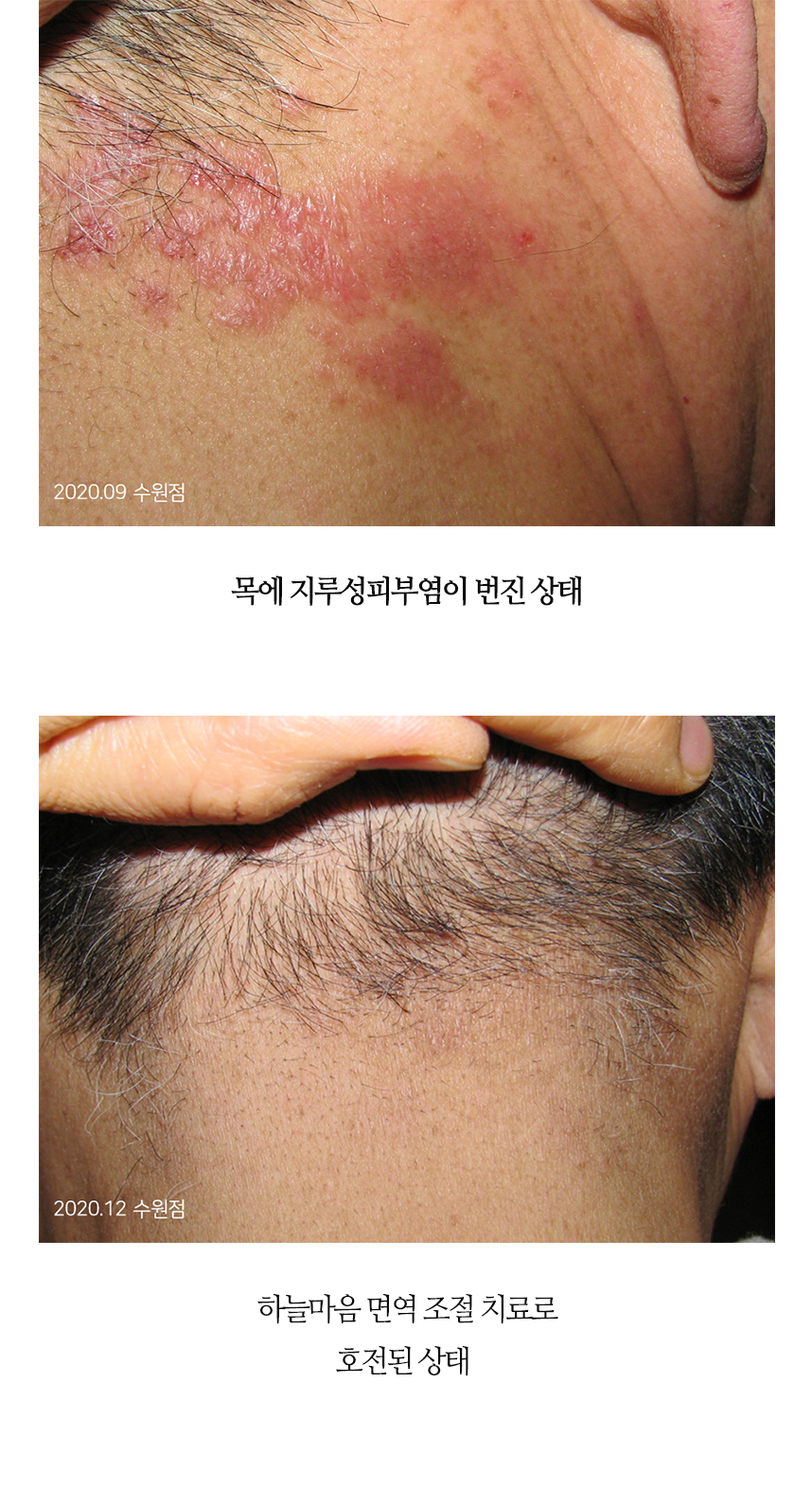 치료전후 이미지2