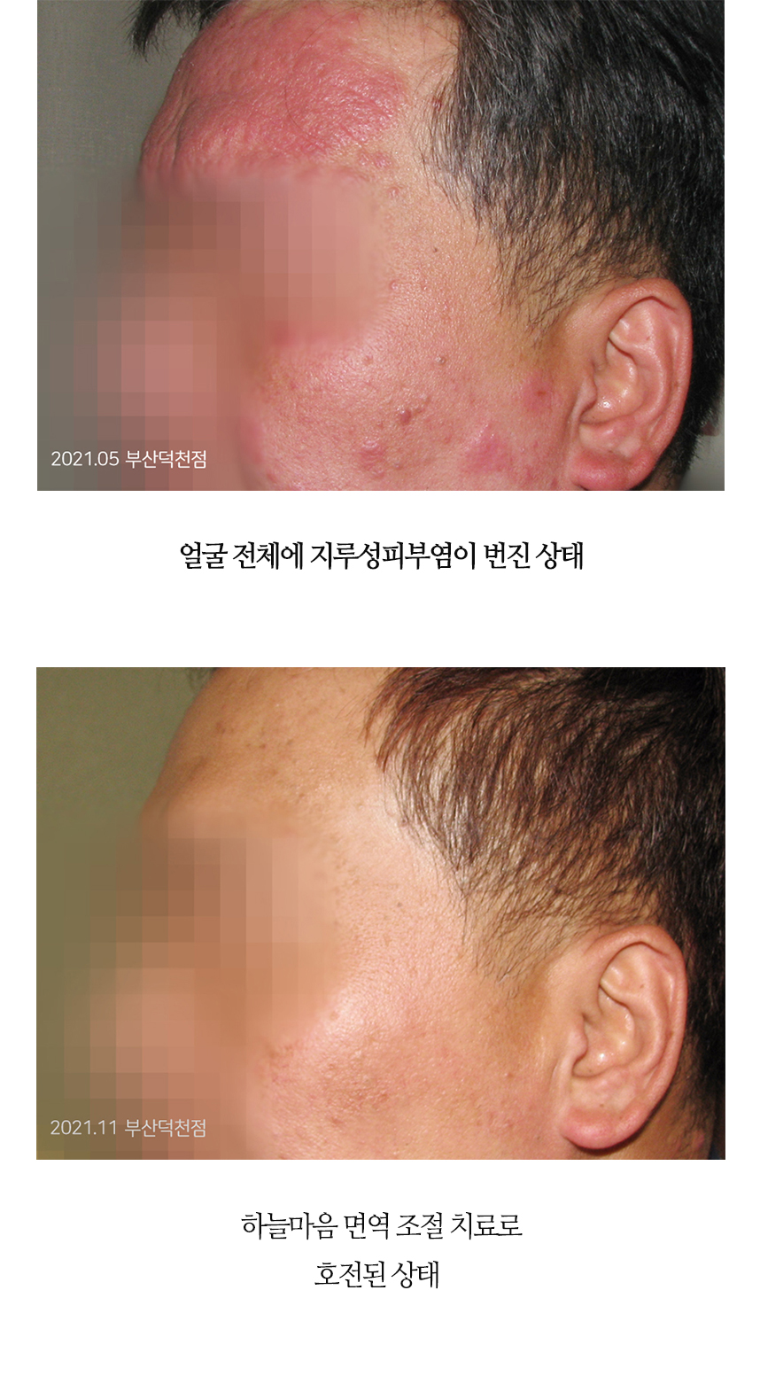 치료전후 이미지3