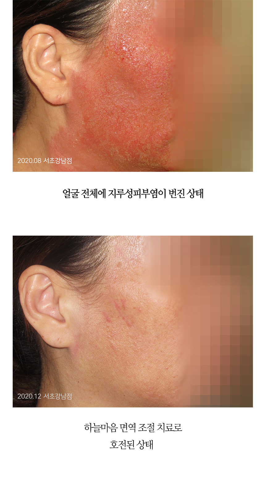 치료전후 이미지4