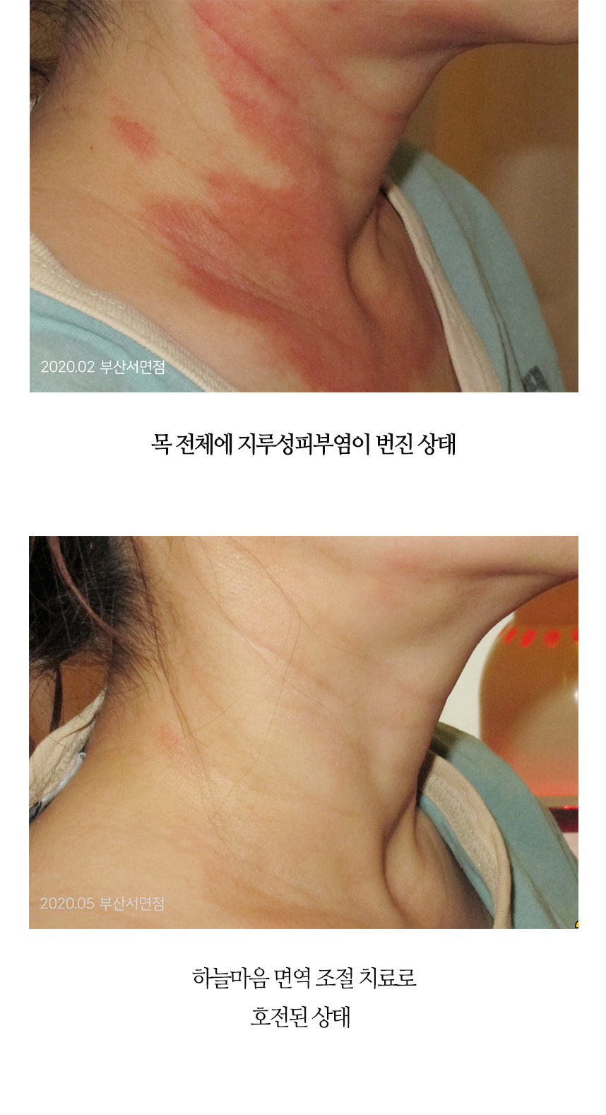 치료전후 이미지5