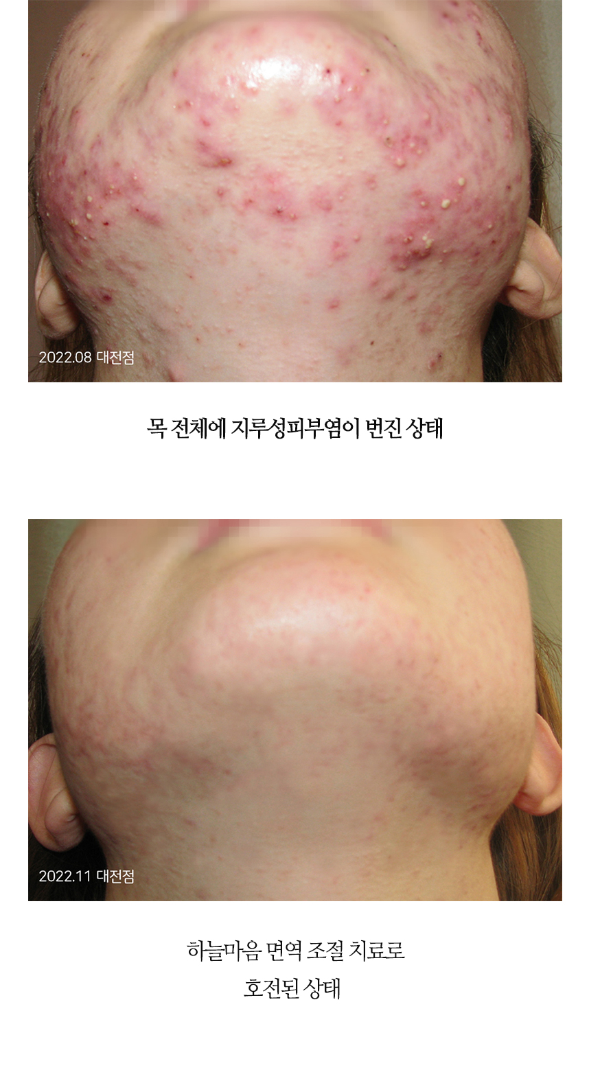 치료전후 이미지6