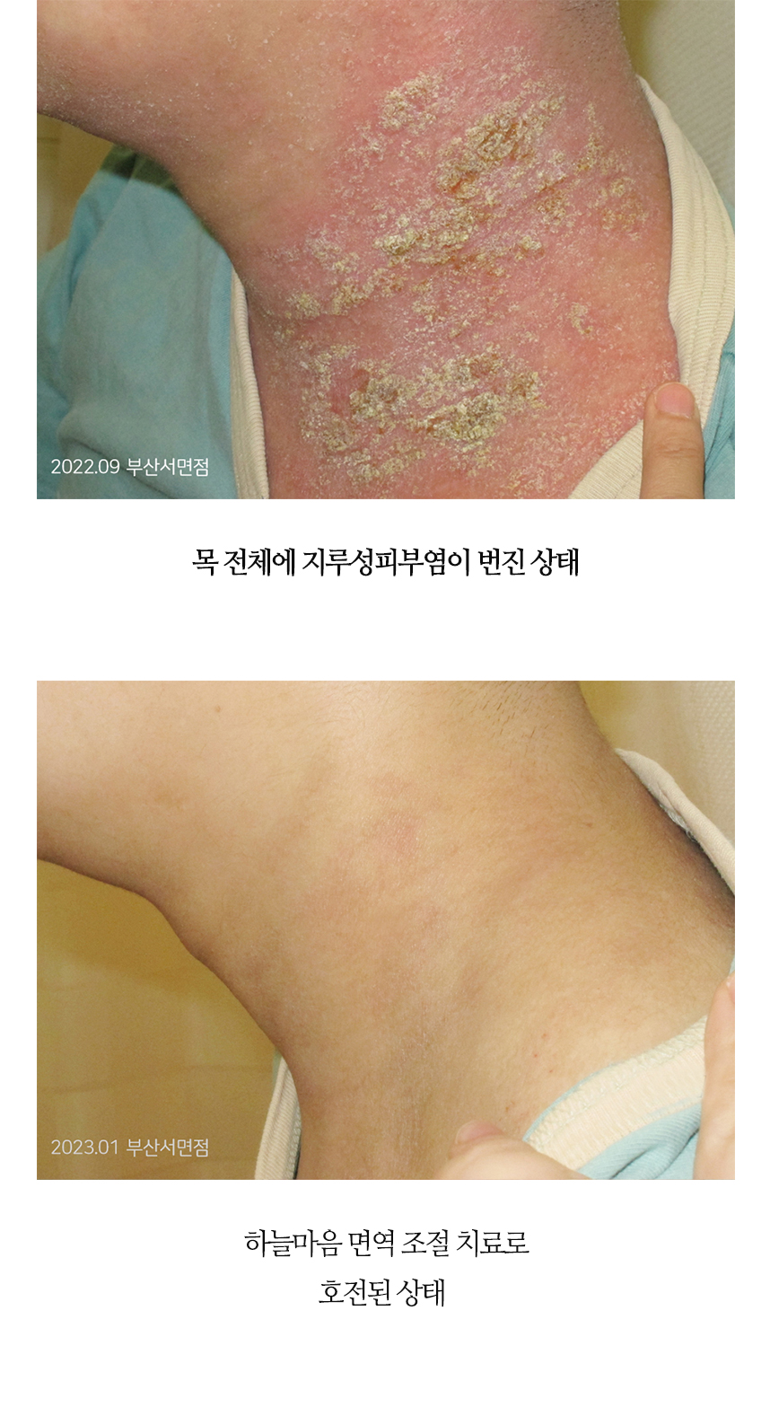 치료전후 이미지7