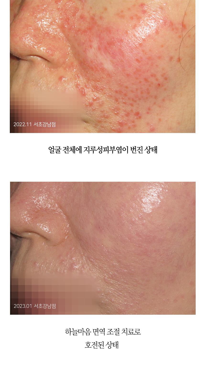 치료전후 이미지8