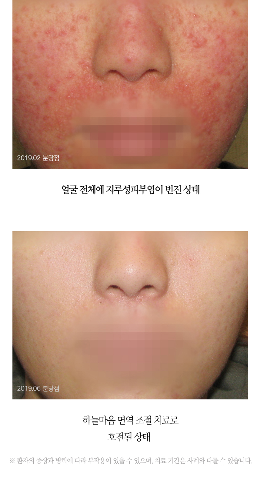 치료전후 이미지9