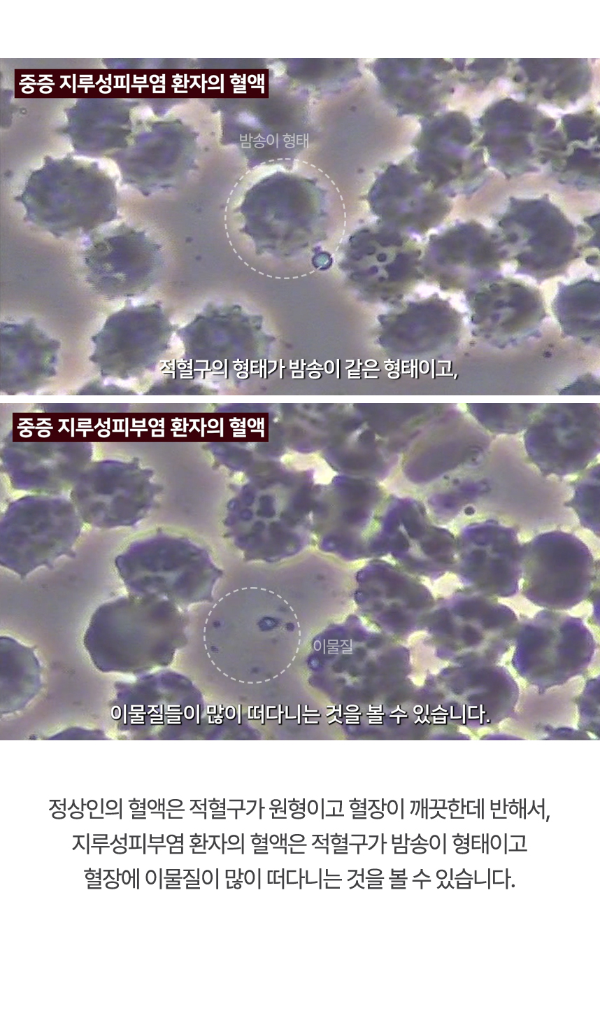 정상인의 혈액은 적혈구가 원형이고 혈장이 깨끗한데 반해서, 지루성피부염 환자의 혈액은 적혈구가 밤송이 형태이고 혈장에 이물질이 많이 떠다니는 것을 볼 수 있습니다.