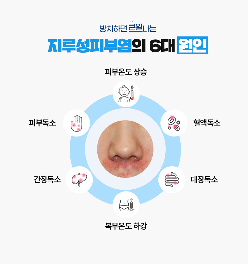또한 지루성피부염 증상이 있는 피부 온도는 높게 상승되어 있고 복부 온도는 낮게 하강되어 있는 병리적인 특성이 있어 이 6가지를 지루성피부염이 발병하는 6대 원인으로 보고 있습니다.