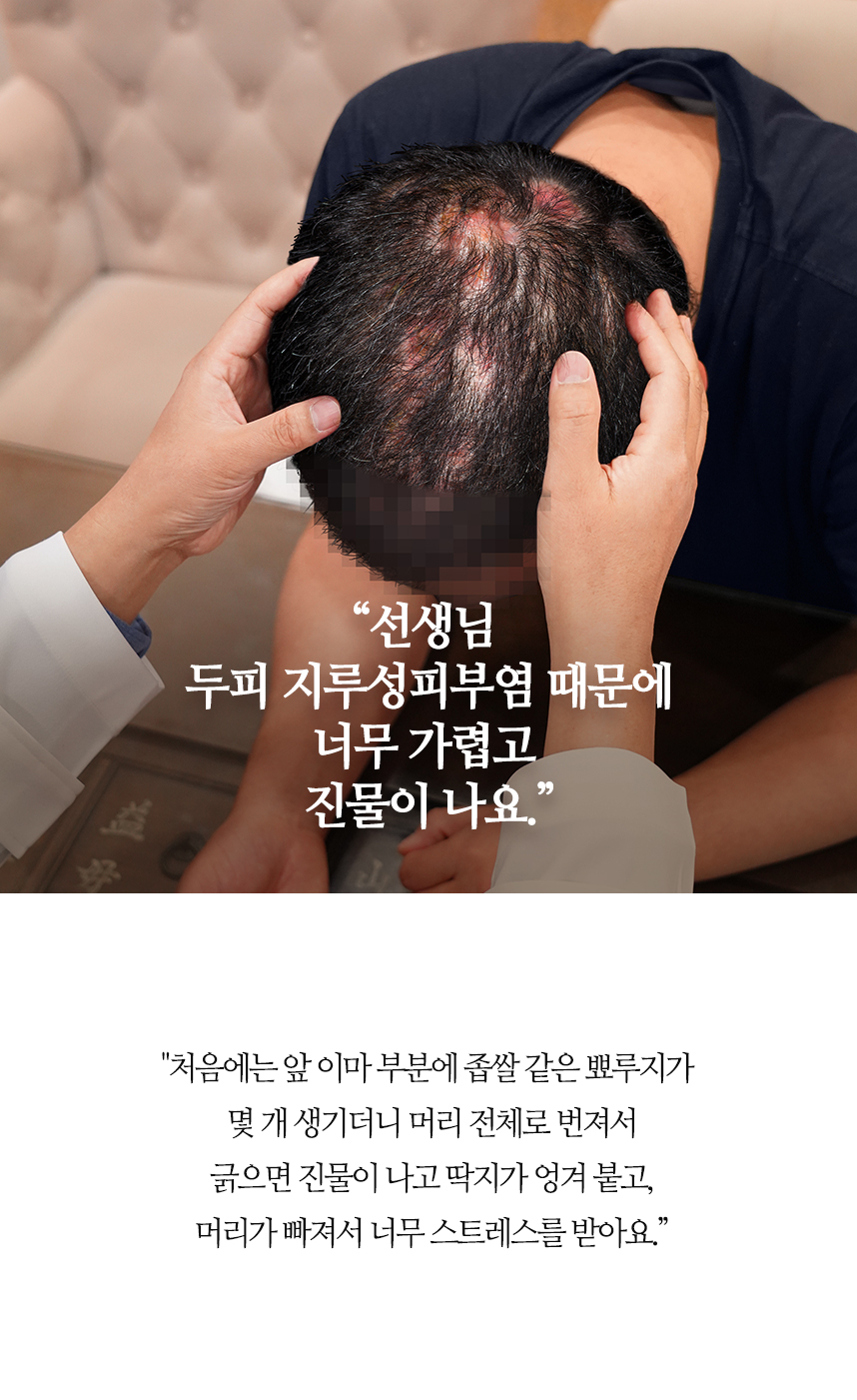 선생님 두피 지루성피부염 때문에 너무 가렵고 진물이 나요