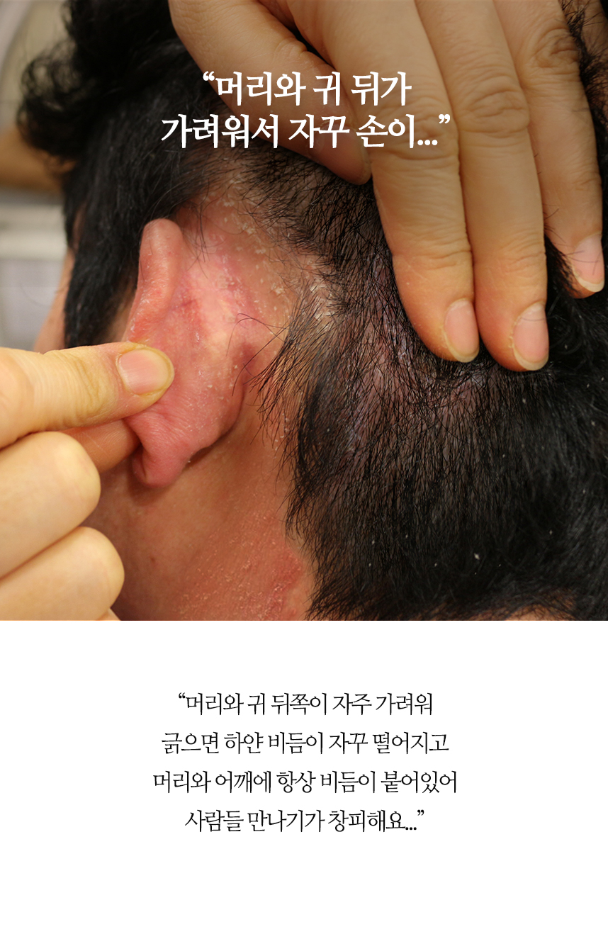 머리와 귀 뒤가 가려워서 자꾸 손이 갔어요...