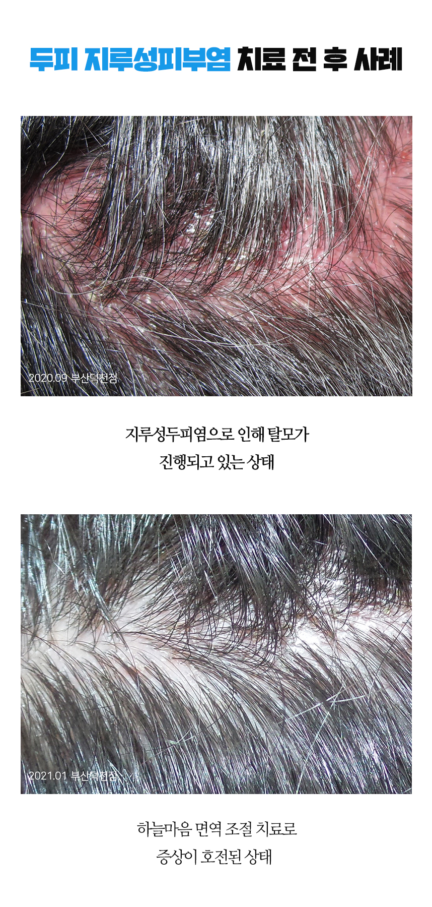 치료전후 이미지1