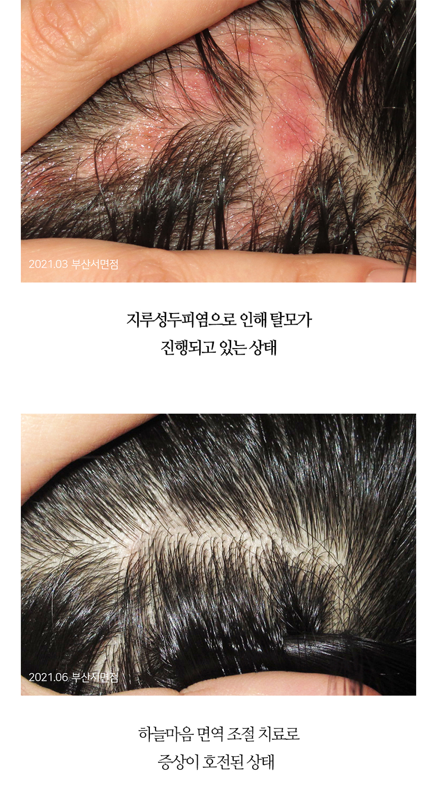 치료전후 이미지2