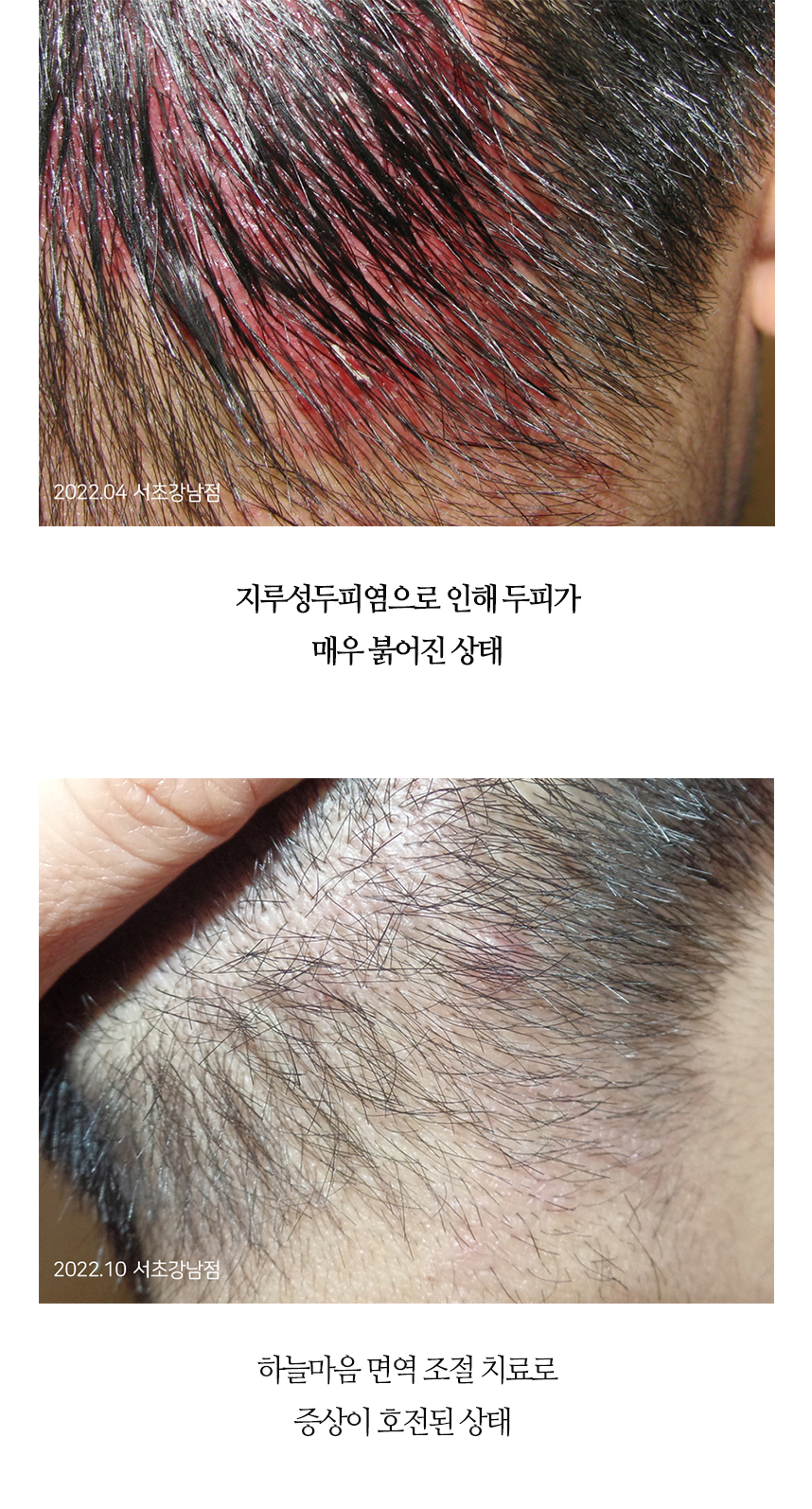 치료전후 이미지3