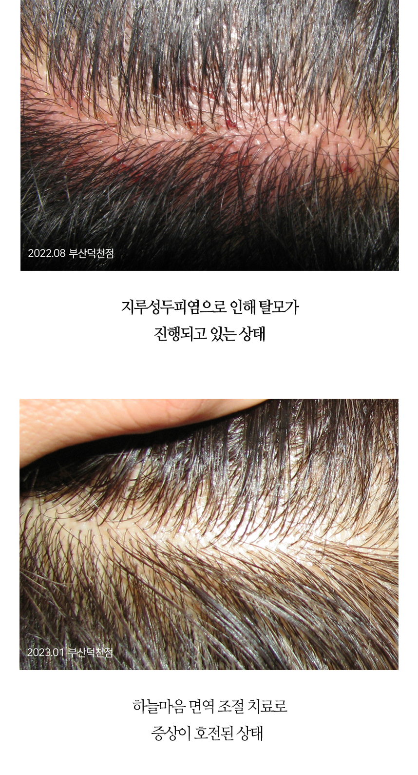치료전후 이미지4