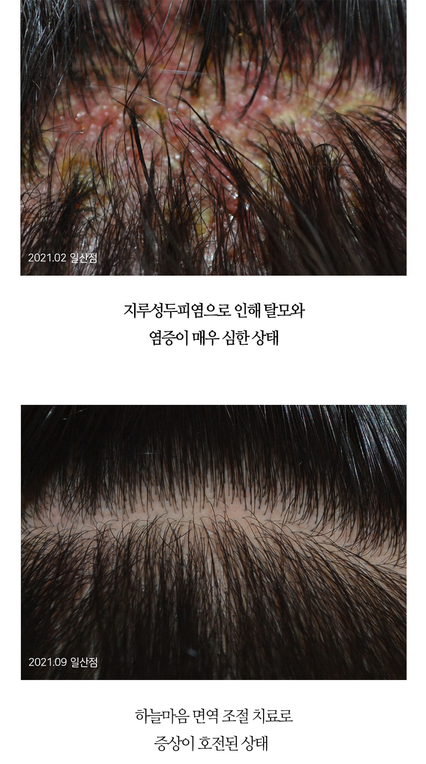 치료전후 이미지5