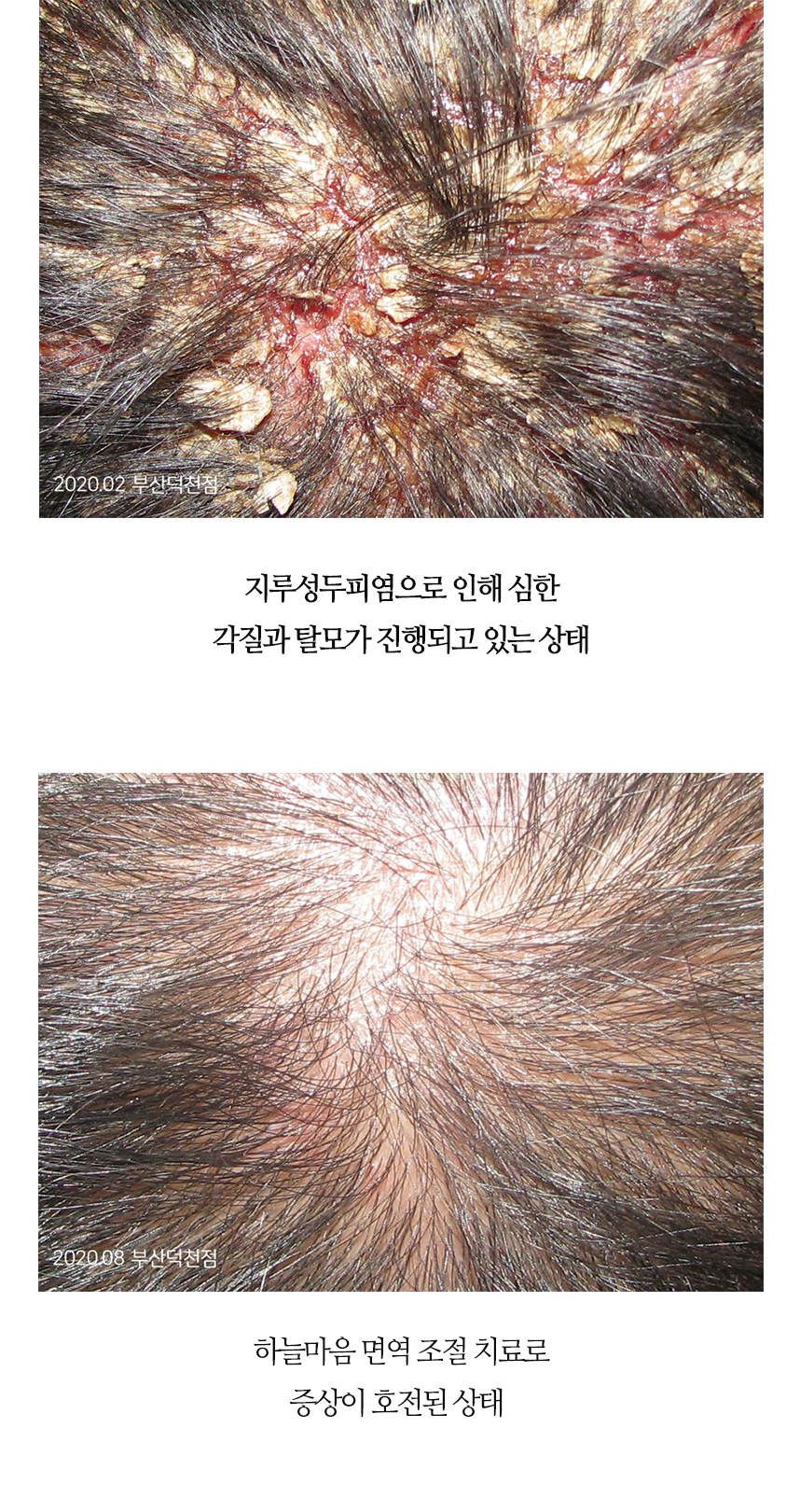 치료전후 이미지6