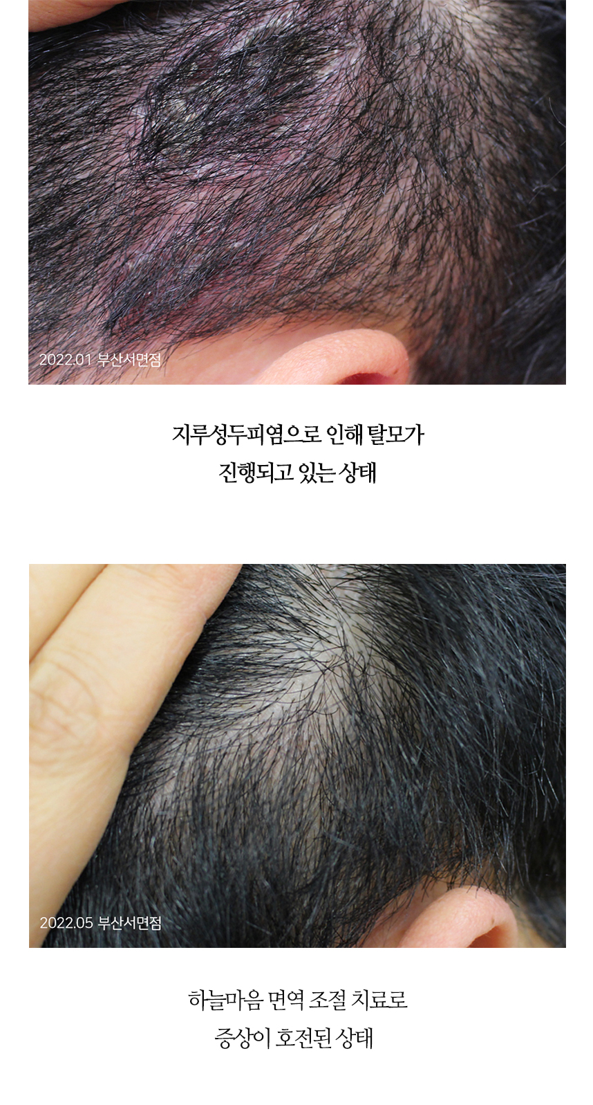 치료전후 이미지7