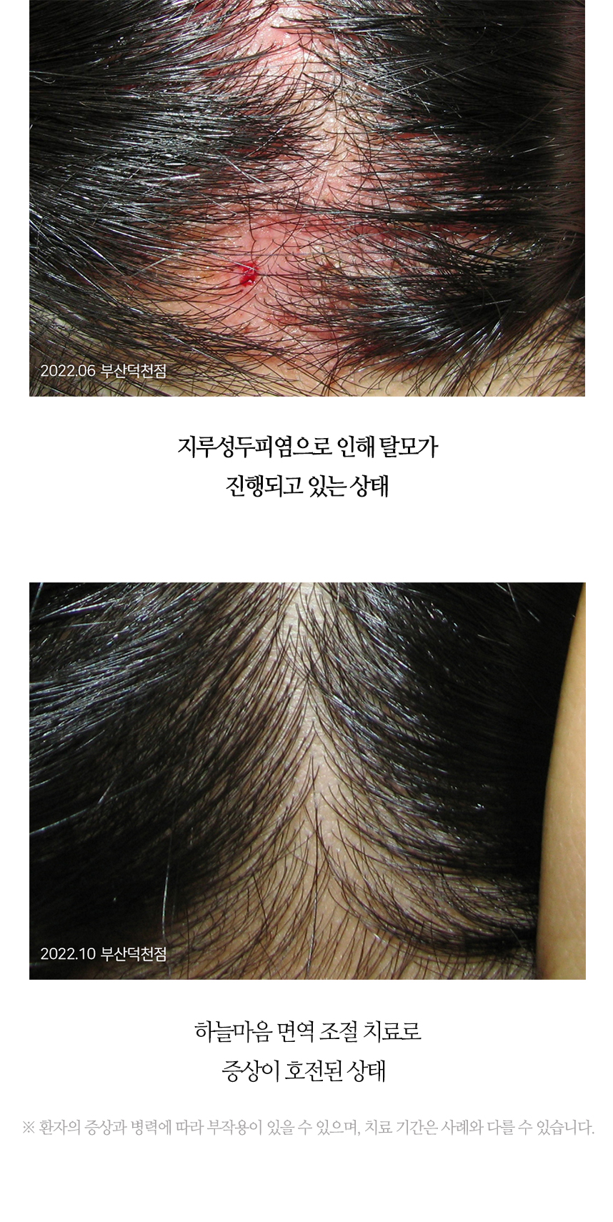 치료전후 이미지8