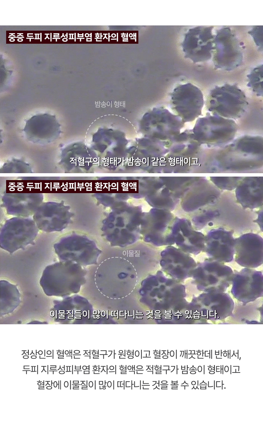 정상인의 혈액은 적혈구가 원형이고 혈장이 깨끗한데 반해서, 두피 지루성피부염 환자의 혈액은 적혈구가 밤송이 형태이고 혈장에 이물질이 많이 떠다니는 것을 볼 수 있습니다.