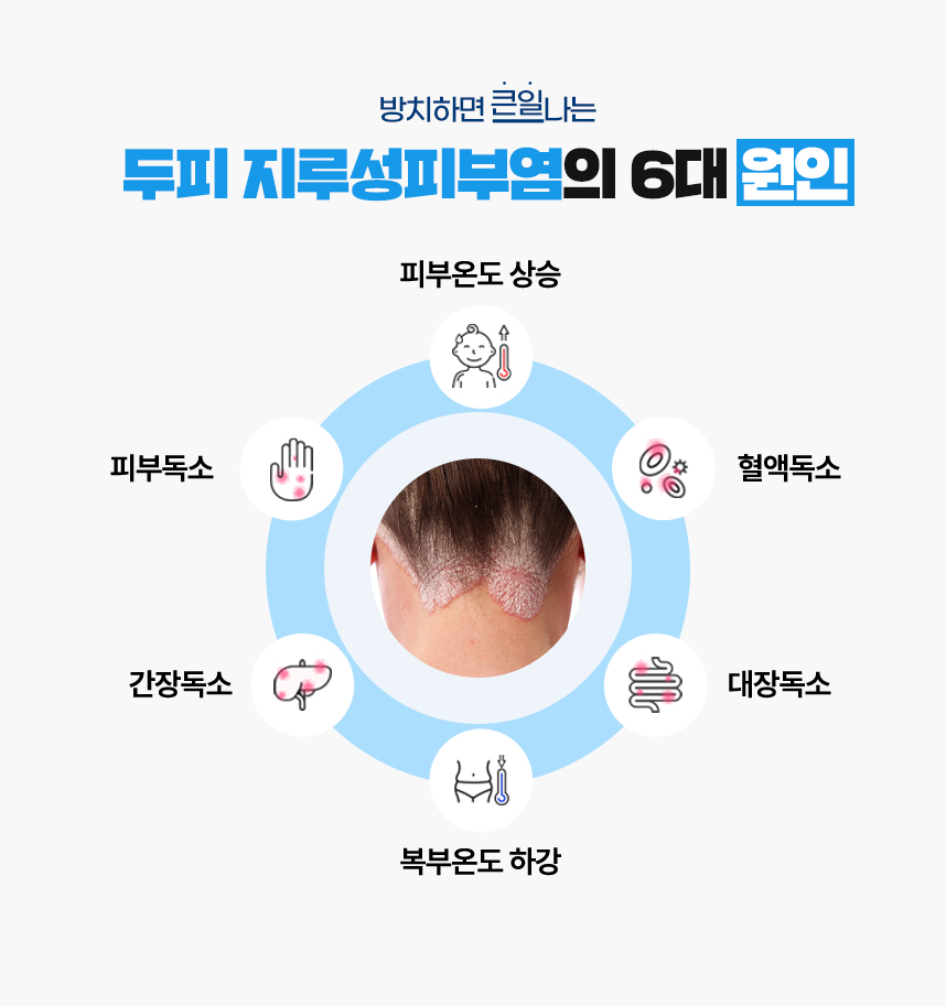 또한 두피 지루성피부염 증상이 있는 피부 온도는 높게 상승되어 있고 복부 온도는 낮게 하강되어 있는 병리적인 특성이 있어 이 6가지를 두피 지루성피부염이 발병하는 6대 원인으로 보고 있습니다.