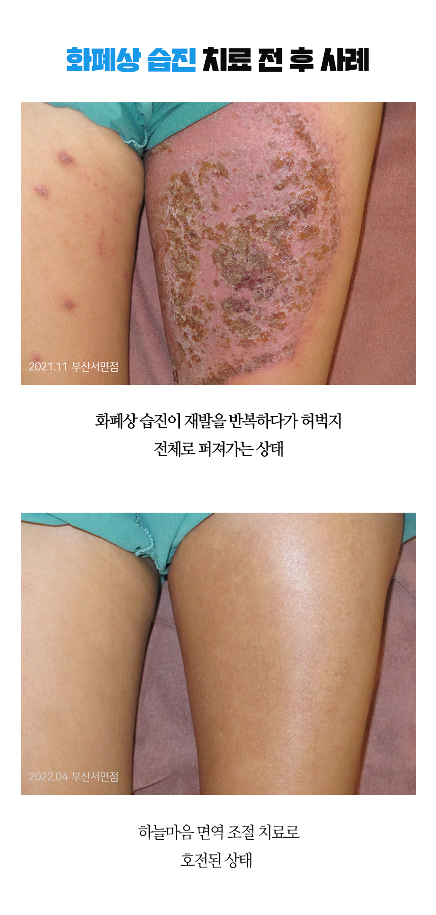 치료전후 이미지1