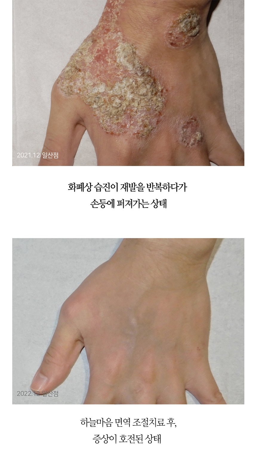 치료전후 이미지4
