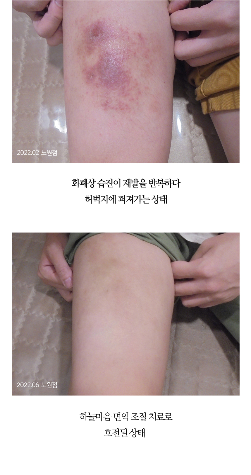 치료전후 이미지6