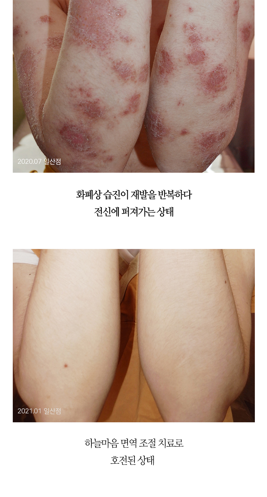 치료전후 이미지7