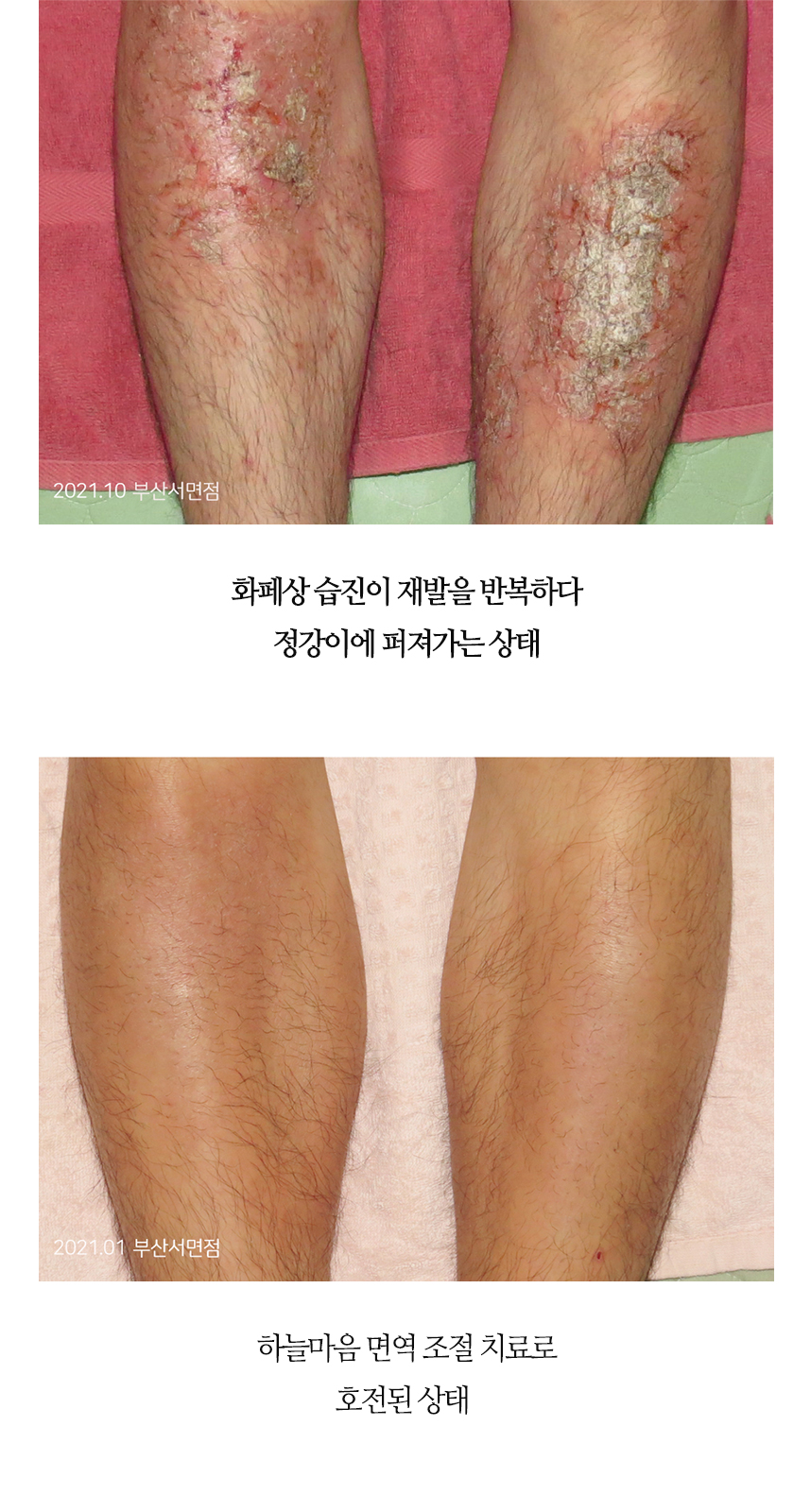 치료전후 이미지8