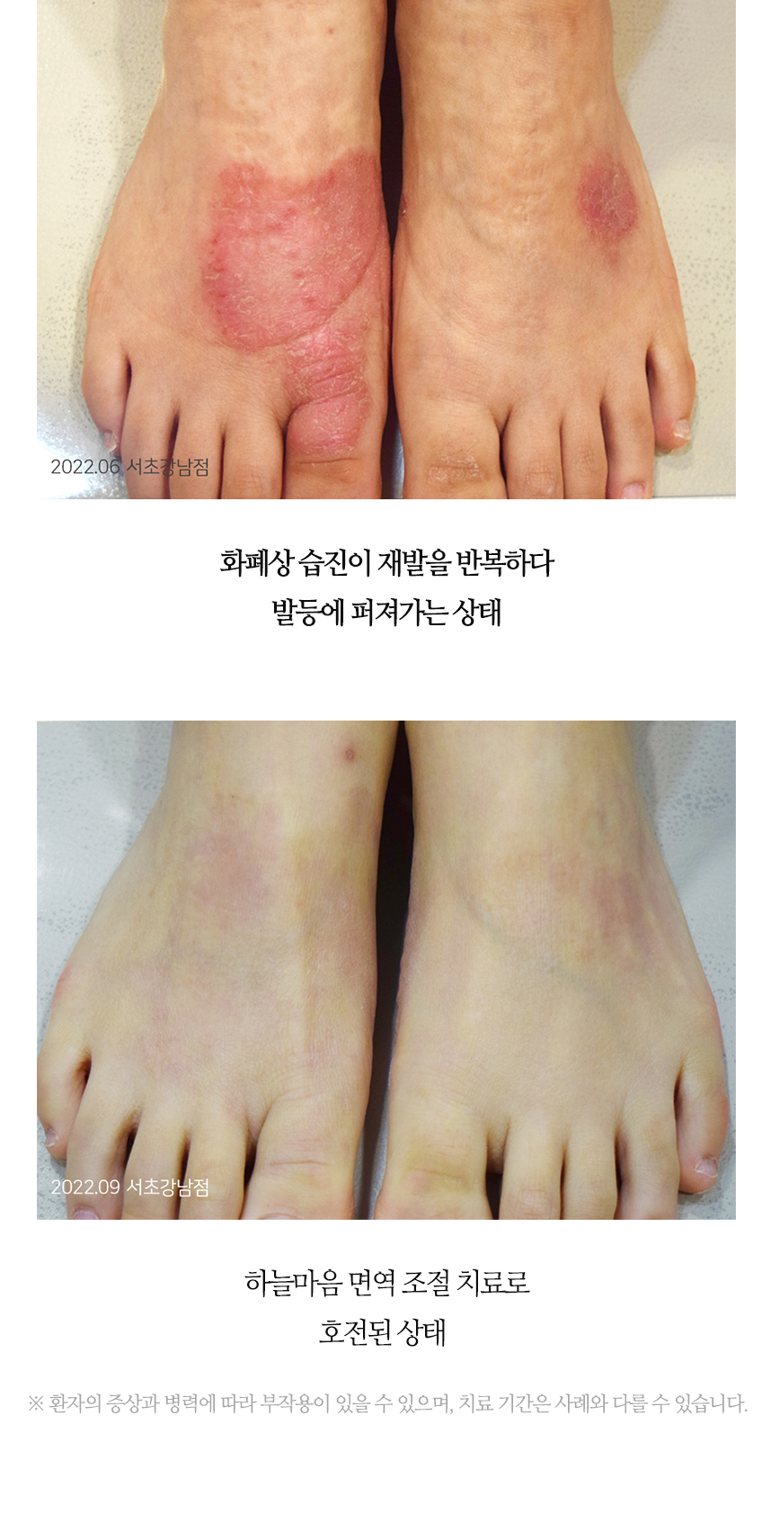 치료전후 이미지9