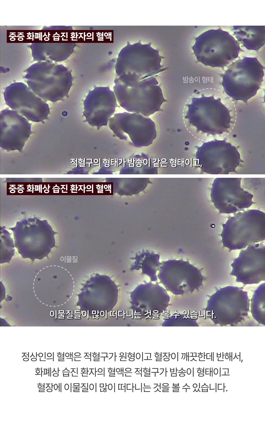정상인의 혈액은 적혈구가 원형이고 혈장이 깨끗한데 반해서, 화폐상 습진 환자의 혈액은 적혈구가 밤송이 형태이고 혈장에 이물질이 많이 떠다니는 것을 볼 수 있습니다.