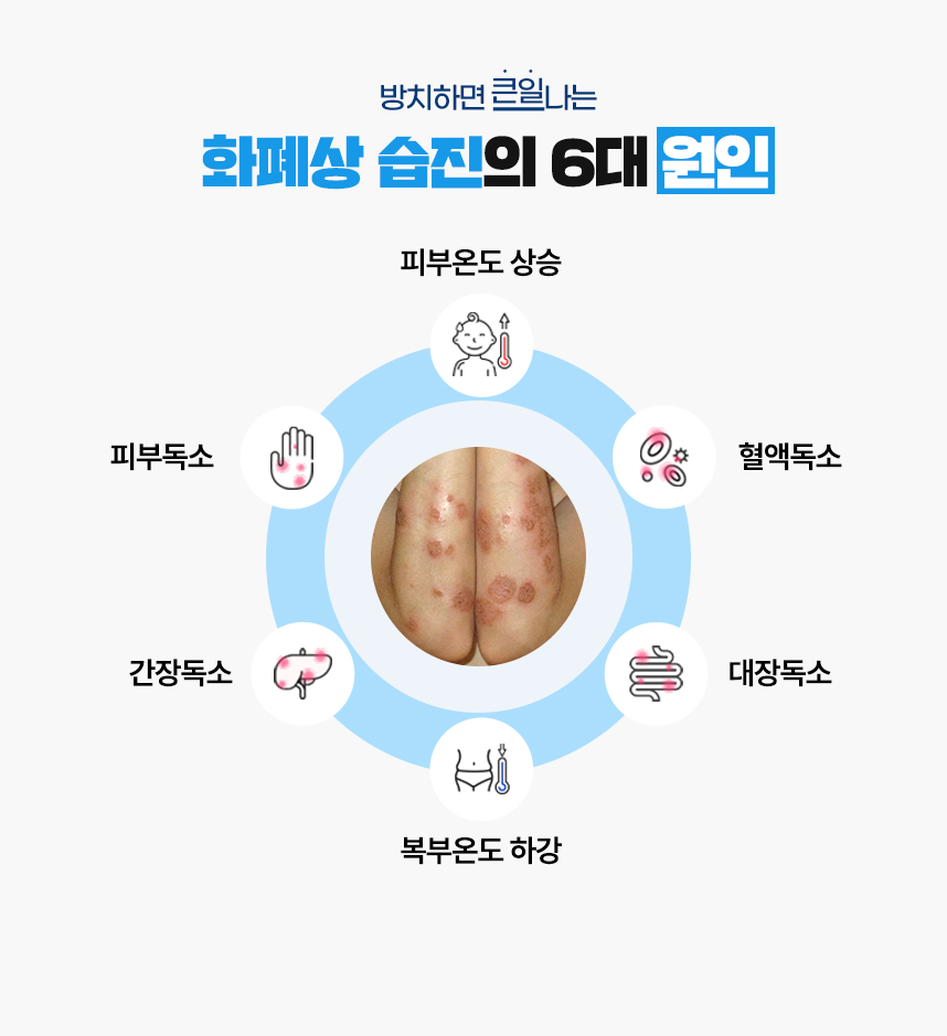 또한 화폐상 습진 증상이 있는 피부 온도는 높게 상승되어 있고 복부 온도는 낮게 하강되어 있는 병리적인 특성이 있어 이 6가지를 화폐상 습진이 발병하는 6대 원인으로 보고 있습니다.
