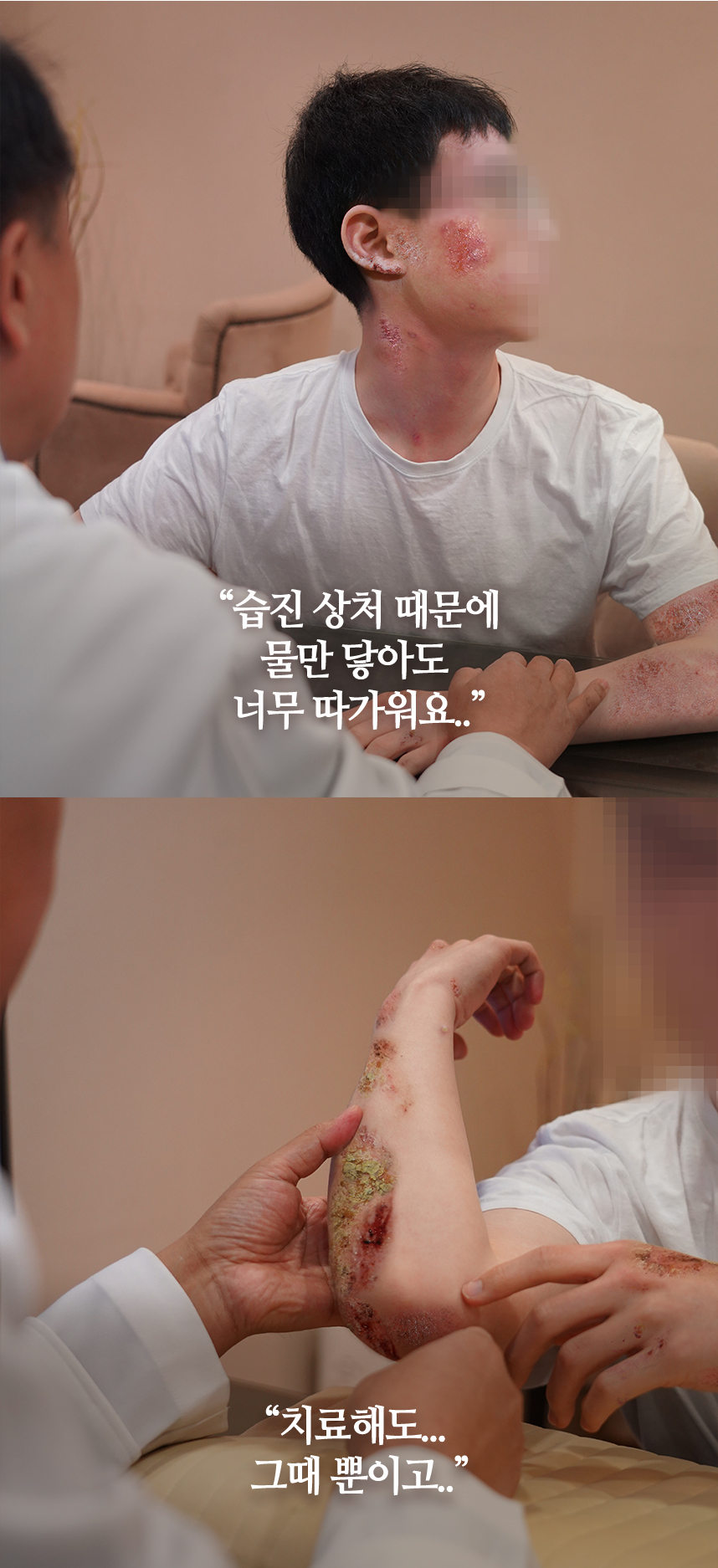 습진 상처 때문에 물만 닿아도 너무 따가워요...치료해도 그떄 뿐이고
