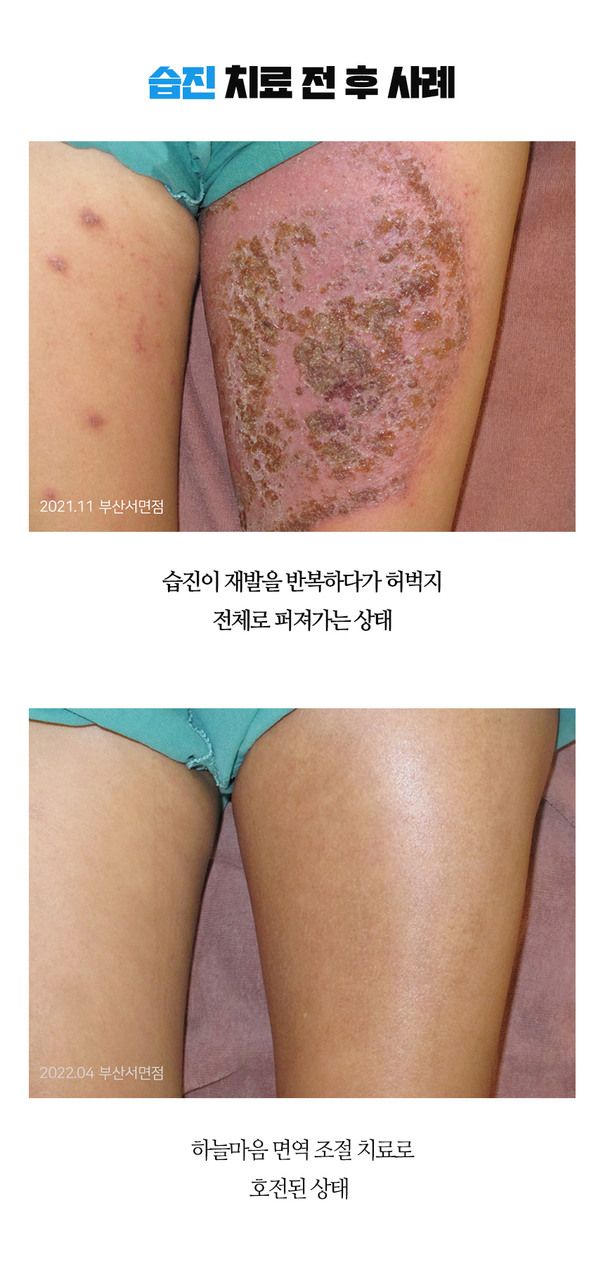 치료전후 이미지1