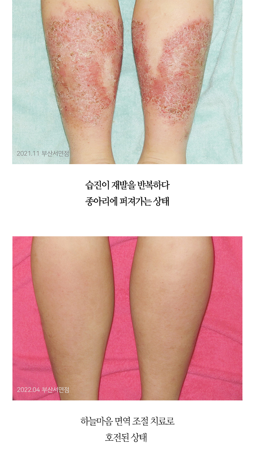 치료전후 이미지2
