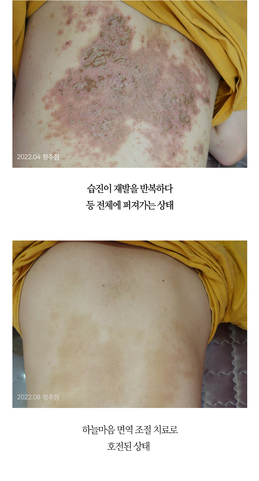 치료전후 이미지3